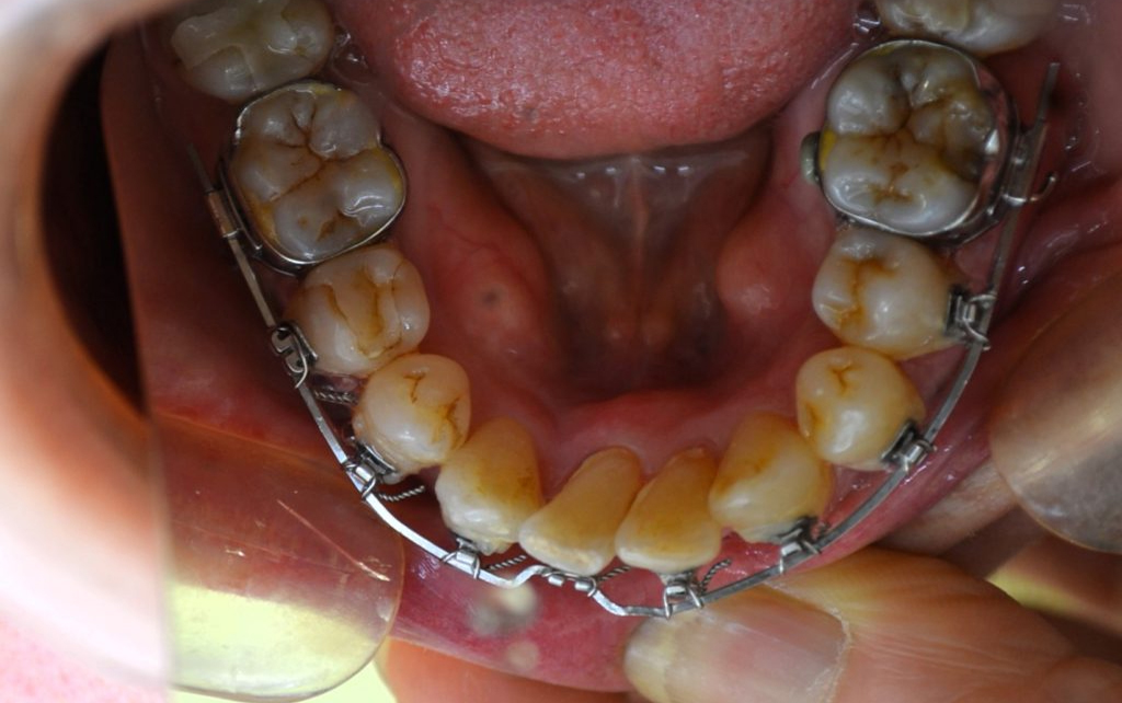 歯列矯正中の下顎